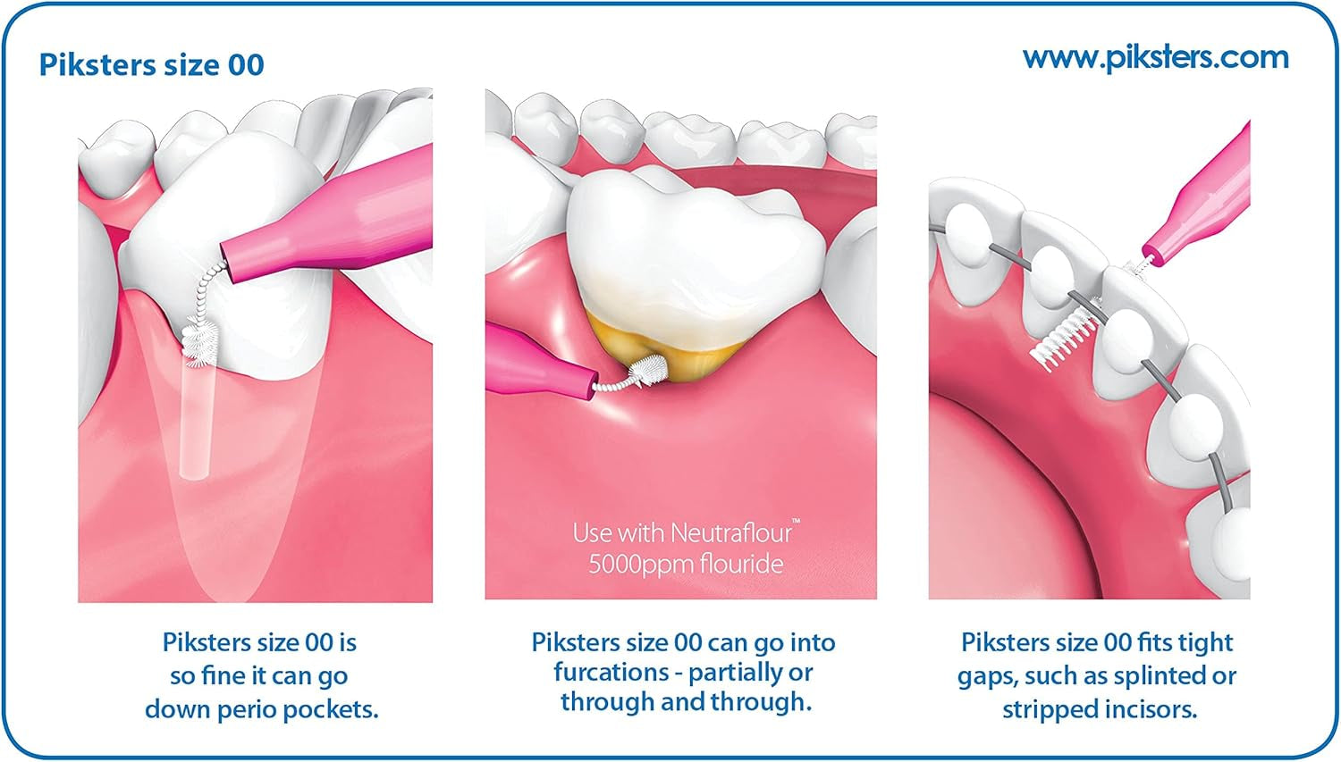 Interdental Brushes (40 Pack, Size 00 (Pink))