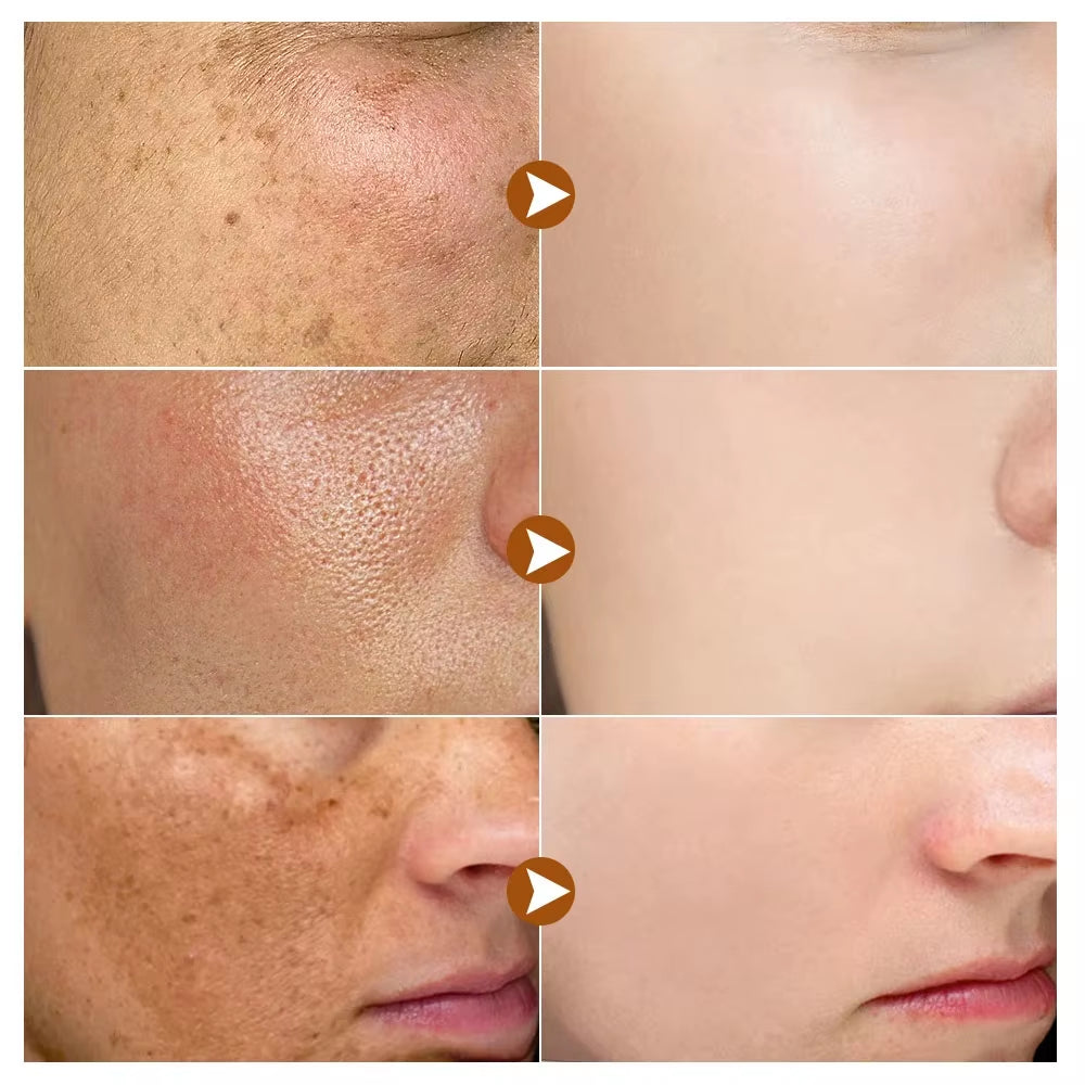 Powerful Dark Spots Remover Whitening Serum Face Freckle Melanin Correcting anti Pigmentation Brighten Skin Beauty Care Products